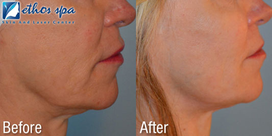 Combining Ultherapy and Sculptra for Longer Lasting Results