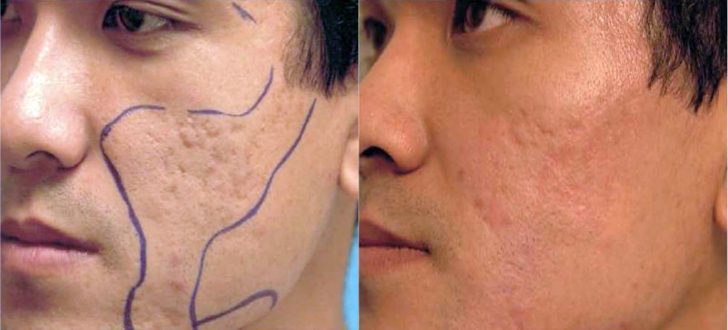 Advances in Laser Therapies to Treat Acne and Scarring Give Everyone The Opportunity for a Smooth, Glowing Complexion