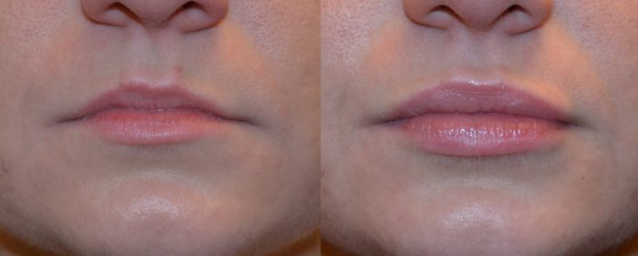 Fuller Lips with Dermal Filler Injections in NJ