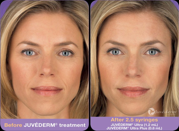 Juvederm: A Facelift Alternative for Achieving a Youthful Look