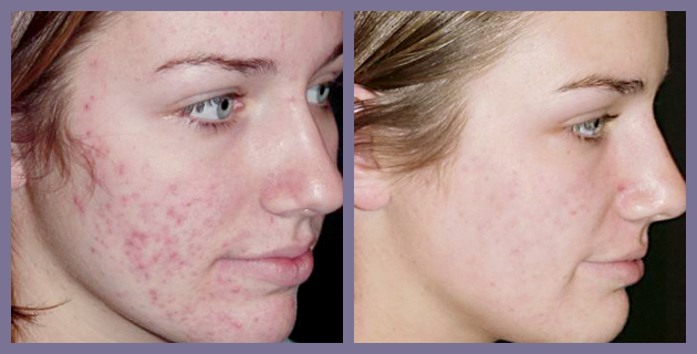 Vbeam an Efficient Solution That Could Get You Rid of Acne