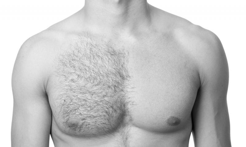 Laser Hair Removal for Men: Are You Ready?