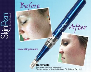 SkinPen Draws Accolades as Anti-Aging breakthrough