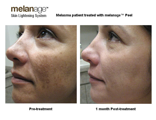 Melanage™ Minipeel™ Benefits