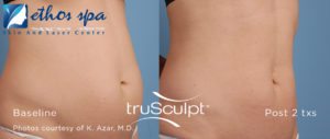 truSculpt_Body_1