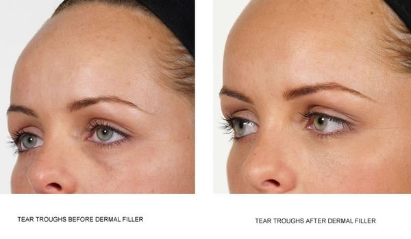 What Is The Best Filler For Tear Troughs Without The Tyndall Effect?