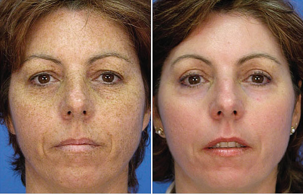 PicoSure Laser Focus For Melasma & Skin Rejuvenation