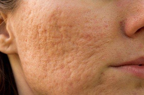 Acne Scar Subcision – Is it For You?