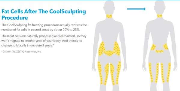 Is CoolSculpting Permanent Fat Removal?