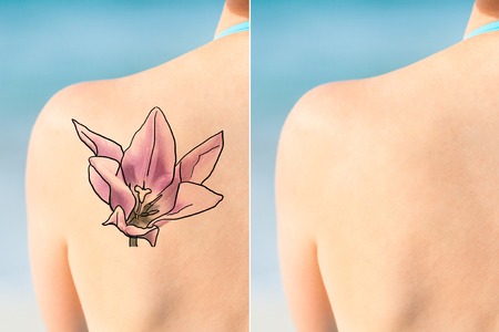 Picosure Laser Can Now Treat All Tattoo Colors And Skin Types