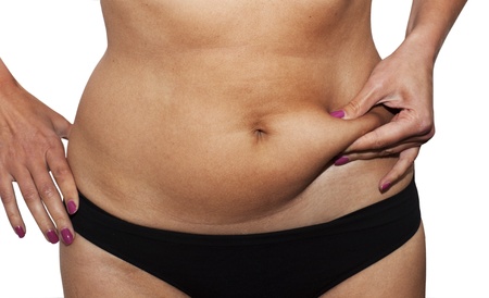 Abdominoplasty Procedure