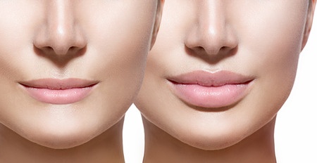 What is Juvederm? How Does It Work?