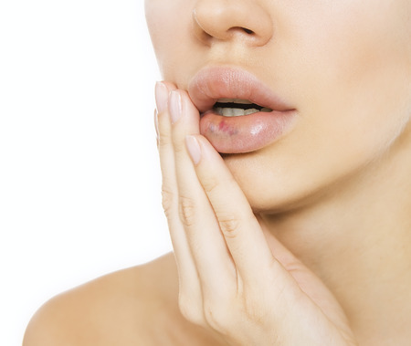 How to Avoid Bruising with Fillers