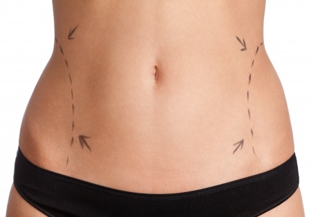 How To Choose Between CoolSculpting And Liposuction