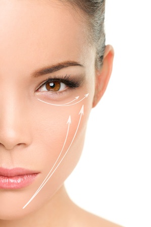 Mini-Facelift Using the Profound Microneedle