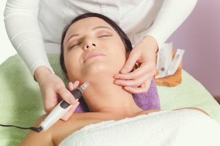 Acne scars and Microneedling