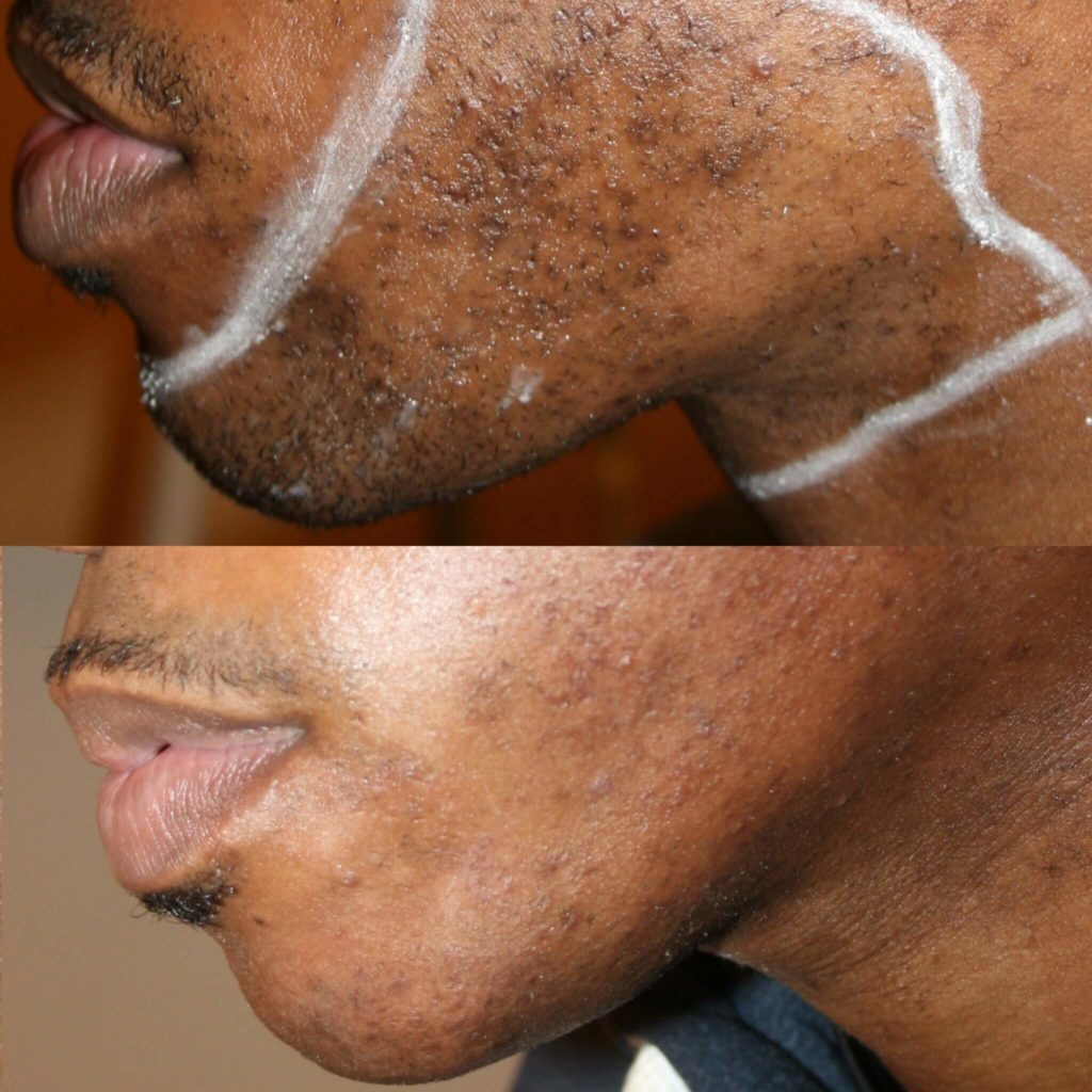 Laser Hair Removal for Men in New Jersey Ethos Spa NJ