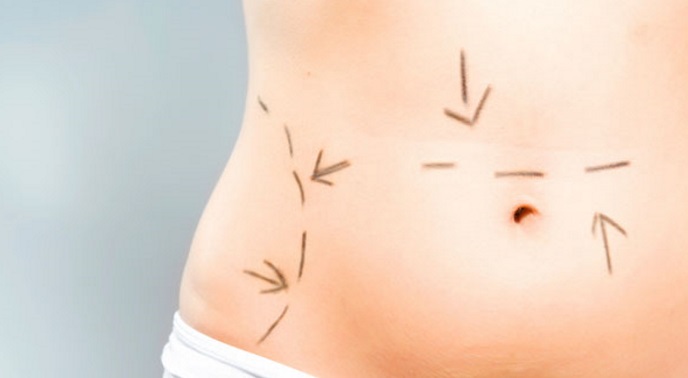 Tummy Tuck Vs. Coolsculpting – Is Surgery the Answer?